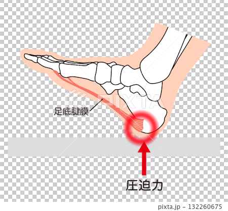 足底筋膜炎 足底筋膜 足底腱膜 足の筋肉 足底筋膜炎 足底筋膜 足底腱膜 足の筋肉 132260675