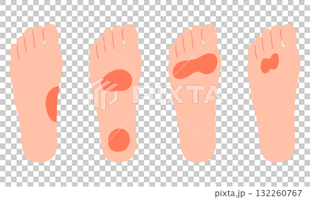 Pain in the soles of the feet - Inflammation 132260767