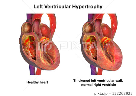 Left ventricular hypertrophy, 3D illustration 132262923