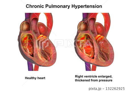 Right ventricular hypertrophy and dilation, 3D illustration 132262925