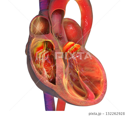 Left ventricular dilation, 3D illustration Left ventricular dilation, 3D illustration 132262928