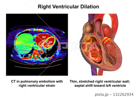 Right ventricular dilation, 3D illustration with CT scan Right ventricular dilation, 3D illustration with CT scan 132262934