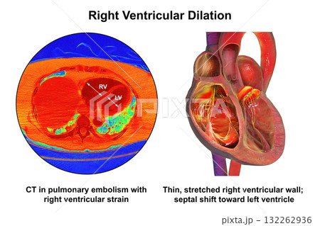 Right ventricular dilation, 3D illustration with CT scan Right ventricular dilation, 3D illustration with CT scan 132262936