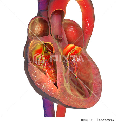 Right ventricular hypertrophy, 3D illustration. Right ventricular hypertrophy, 3D illustration. 132262943