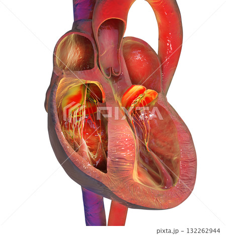 Heart with septal hypertrophy, 3D illustration Heart with septal hypertrophy, 3D illustration 132262944