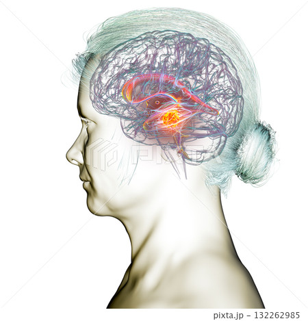 A brain tumor causing hydrocephalus, 3D illustration A brain tumor causing hydrocephalus, 3D illustration 132262985