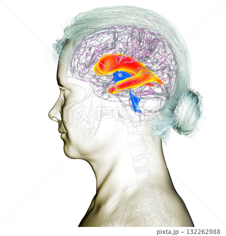 Enlarged lateral ventricles of the brain, 3D illustration Enlarged lateral ventricles of the brain, 3D illustration 132262988