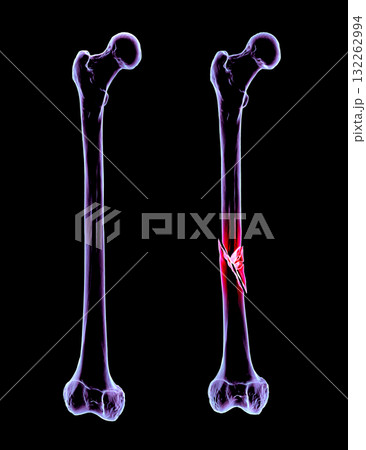 Femur bone with shaft fracture, 3D illustration Femur bone with shaft fracture, 3D illustration 132262994