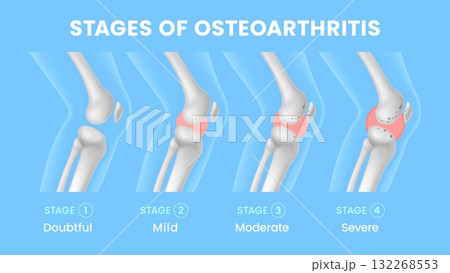 Knee joint osteoarthritis stages. Medical vector infographic chart showing progressive stages like doubtful, mild, moderate and severe, illustrated with increasing cartilage loss and joint damage 132268553
