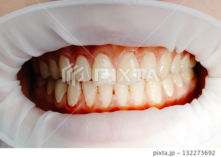 Dentist examining patient teeth using cheek retractor during dental procedure Dentist examining patient teeth using cheek retractor during dental procedure 132273692