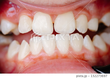 Patient suffering from toothache waiting for dentist in clinic 132273697