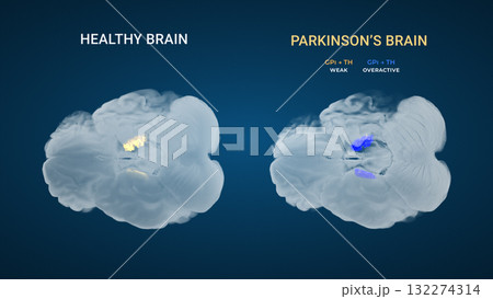 Parkinsons GPi Thalamic Output Imbalance Comparison 132274314