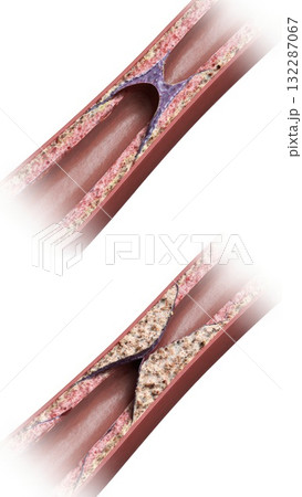 Healthy vs Atherosclerotic Coronary Artery Comparison Healthy vs Atherosclerotic Coronary Artery Comparison 132287067
