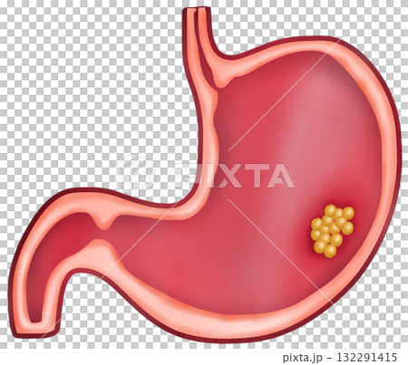Stomach Cancer, Hand-drawn Watercolor Illustration 132291415