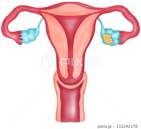 Ovarian Cancer, Hand-drawn Watercolor Illustration 132292178