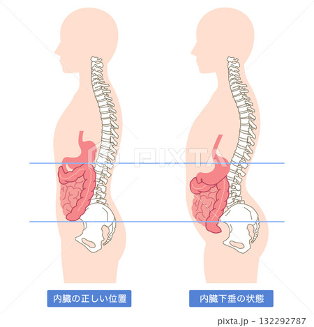 内臓下垂　内臓の位置が下がっている状態 132292787