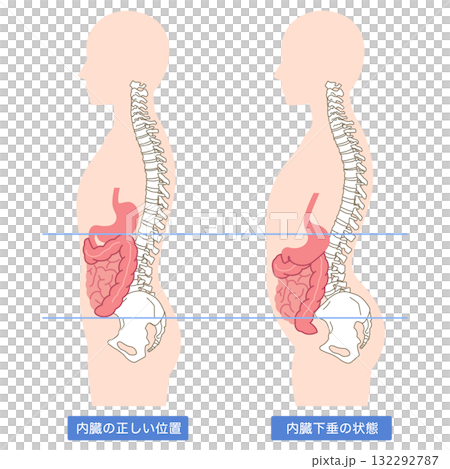 內臟下垂:內臟器官下垂的一種狀況 內臟下垂:內臟器官下垂的一種狀況 132292787
