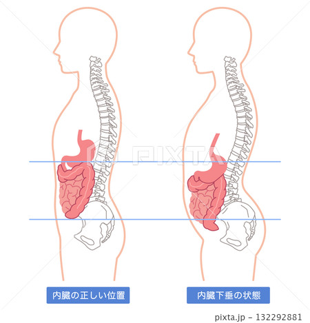 内臓下垂 内臓の位置が下がっている状態 内臓下垂 内臓の位置が下がっている状態 132292881