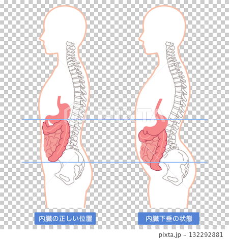 内臓下垂 内臓の位置が下がっている状態 内臓下垂 内臓の位置が下がっている状態 132292881
