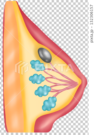 Breast Cysts, Hand-drawn Watercolor Illustration Breast Cysts, Hand-drawn Watercolor Illustration 132306157