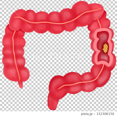 Anatomy of Colorectal Cancer, Hand-drawn Watercolor Illustration 132306158