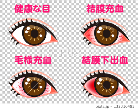 Illustration material set 2 of bloodshot eyes Illustration material set 2 of bloodshot eyes 132310483