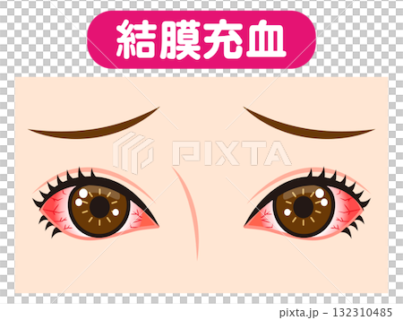雙眼充血、結膜充血的插畫素材 132310485