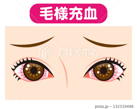 毛様充血で充血した両目のイラスト素材 132310486