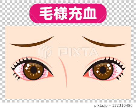 Illustration material of both eyes bloodshot due to ciliary congestion Illustration material of both eyes bloodshot due to ciliary congestion 132310486