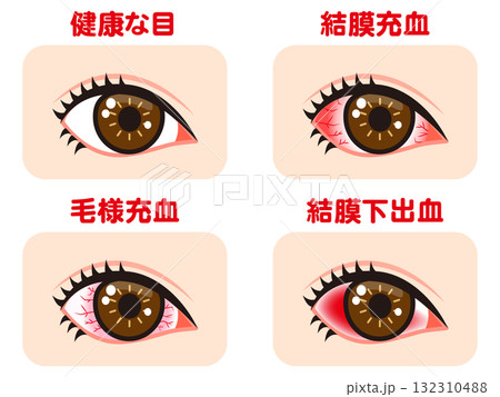 充血した片目の図解イラスト素材セット 132310488
