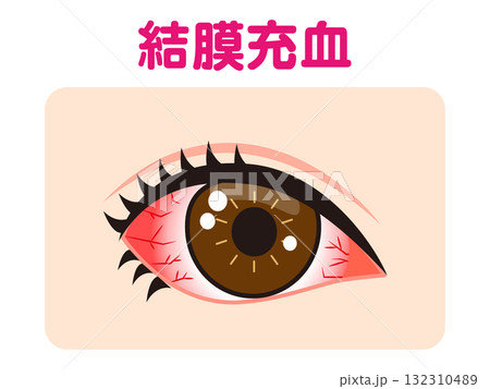 結膜充血で充血した片目のイラスト素材 132310489