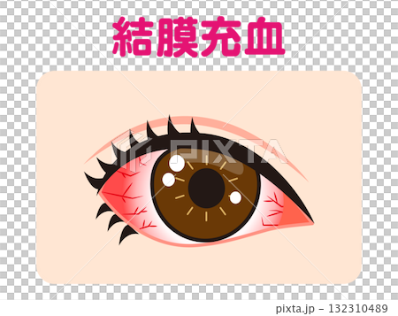 一隻眼睛結膜充血的插圖素材 132310489