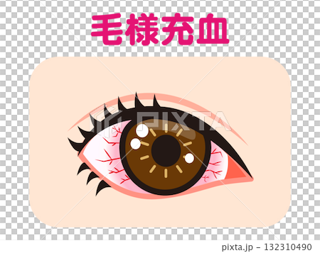Illustration material of one eye bloodshot due to ciliary congestion Illustration material of one eye bloodshot due to ciliary congestion 132310490