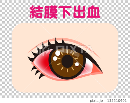 由於結膜下出血導致一隻眼睛充血的插圖素材 132310491