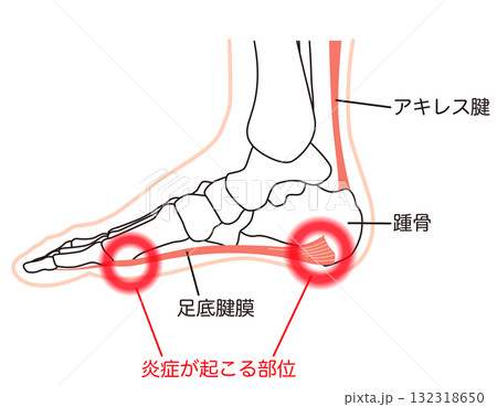 足底筋膜炎　炎症が起こる部位　足底筋膜　足底腱膜 132318650
