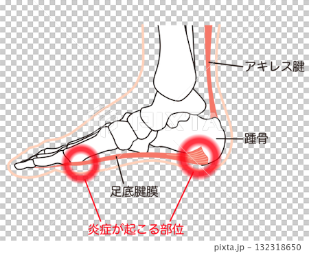 足底筋膜炎　炎症が起こる部位　足底筋膜　足底腱膜 132318650