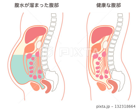 腹水が溜まった腹部と、健康な腹部 腹水が溜まった腹部と、健康な腹部 132318664