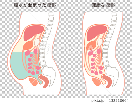 腹水が溜まった腹部と、健康な腹部 腹水が溜まった腹部と、健康な腹部 132318664