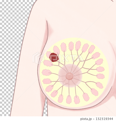 乳癌 II 期(第二階段)簡單易懂的插圖 乳癌 II 期(第二階段)簡單易懂的插圖 132319344