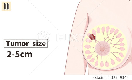 乳がん　ステージⅡ（2期）　わかりやすい英語図解イラスト 132319345