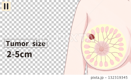 乳がん　ステージⅡ（2期）　わかりやすい英語図解イラスト 132319345