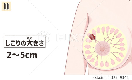 乳がん ステージⅡ(2期) わかりやすい日本語図解イラスト 乳がん ステージⅡ(2期) わかりやすい日本語図解イラスト 132319346