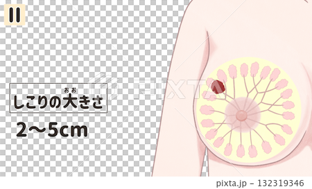 乳がん　ステージⅡ（2期）　わかりやすい日本語図解イラスト 132319346