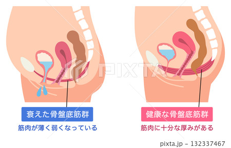 衰えた骨盤底筋群と健康な骨盤底筋群 衰えた骨盤底筋群と健康な骨盤底筋群 132337467