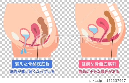 衰えた骨盤底筋群と健康な骨盤底筋群 衰えた骨盤底筋群と健康な骨盤底筋群 132337467