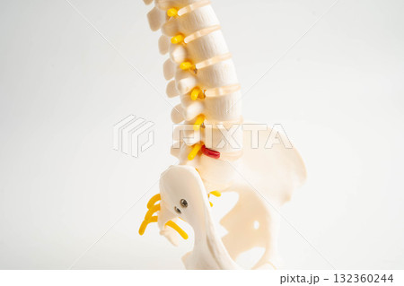 Spinal nerve and bone, Lumbar spine displaced herniated disc fragment, Model for treatment medical in the orthopedic department. Spinal nerve and bone, Lumbar spine displaced herniated disc fragment, Model for treatment medical in the orthopedic department. 132360244
