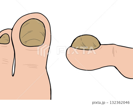 肥厚爪のイラスト 肥厚爪のイラスト 132362046
