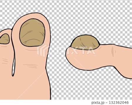 肥厚爪のイラスト 肥厚爪のイラスト 132362046