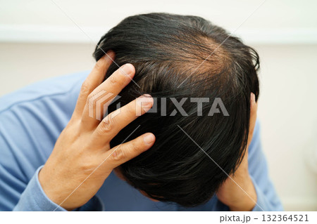 Bald head in man, hair loss treatment health problem. 132364521
