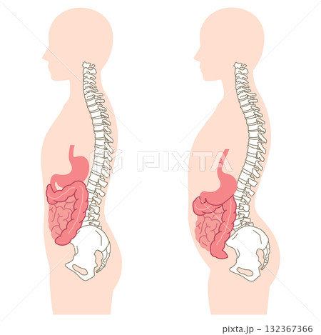 内臓下垂　内臓の位置が下がっている状態 132367366